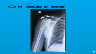 20
Film Rt. Shoulder AP (postop)
 
