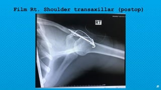 21
Film Rt. Shoulder transaxillar (postop)
 