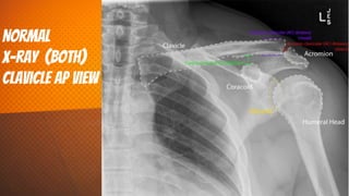 NorMal
x-ray (both)
clavicle AP view
33
 