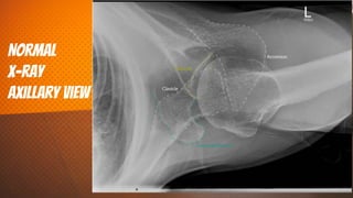 NorMal
x-ray
axillary view
35
 
