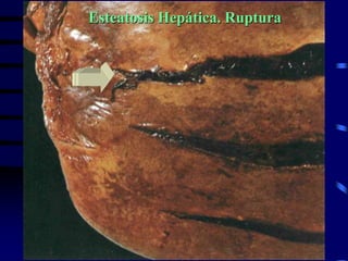 Acino HepáTico