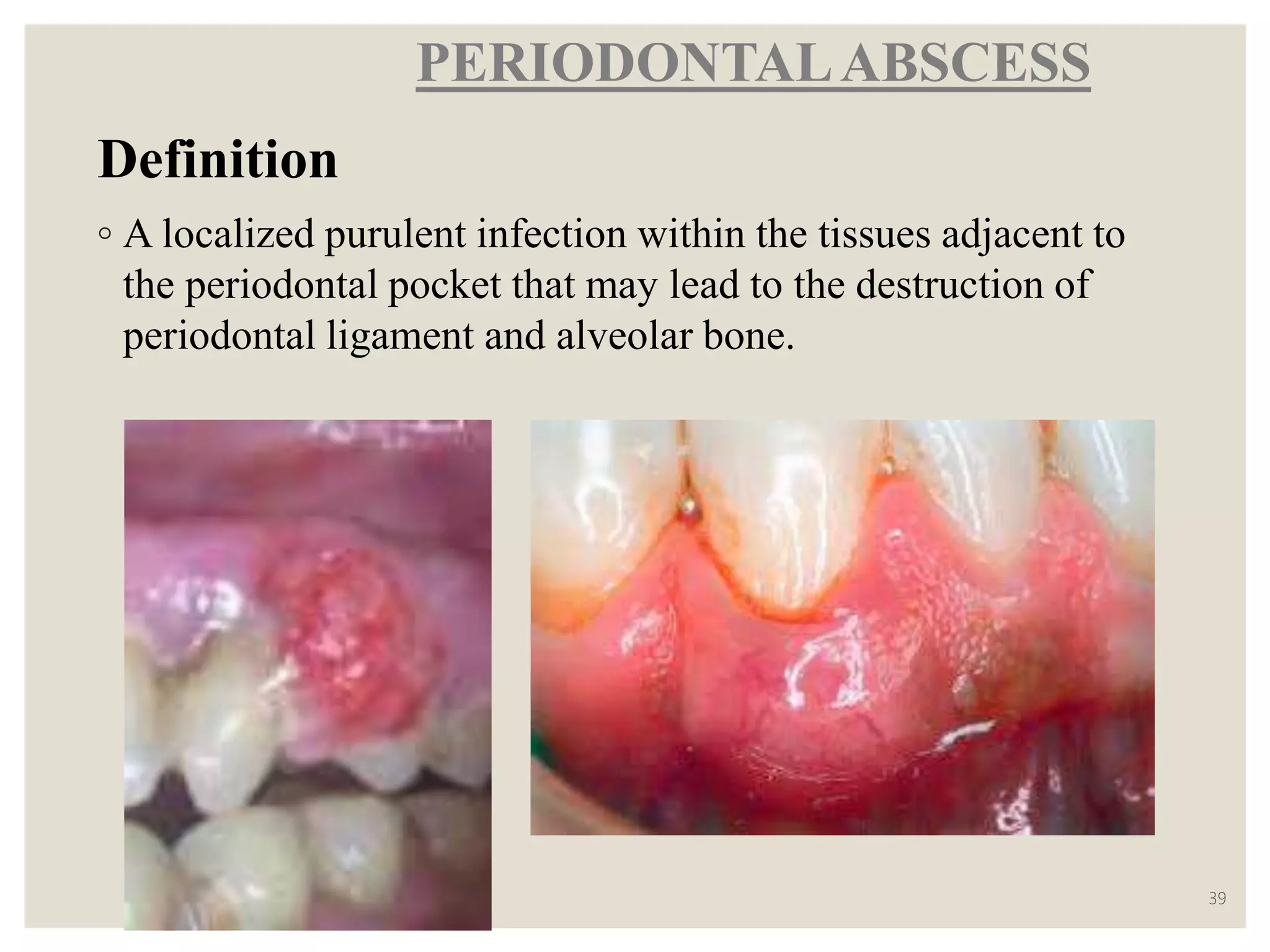 ACUTE GINGIVAL INFECTIONS | PPTX
