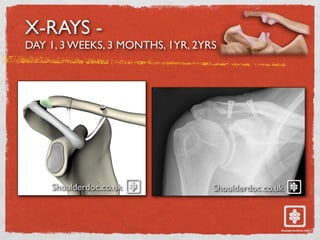 X-RAYS -
DAY 1, 3 WEEKS, 3 MONTHS, 1YR, 2YRS
Shoulderdoc.co.uk Shoulderdoc.co.uk
 