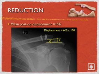 REDUCTION
Mean post-op displacement =15%
B
A
Displacement = A/B x 100
 