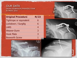 Original Procedure N/23
Tightrope or equivalent 6
Lockdown / Surgilig 6
LARS 4
Weaver-Dunn 3
Hook Plate 3
Bosworth Screw 1
OUR DATA
DESAIS, ROBINSON, PHANDIS, FUNK
IN PRINT, 2016
 
