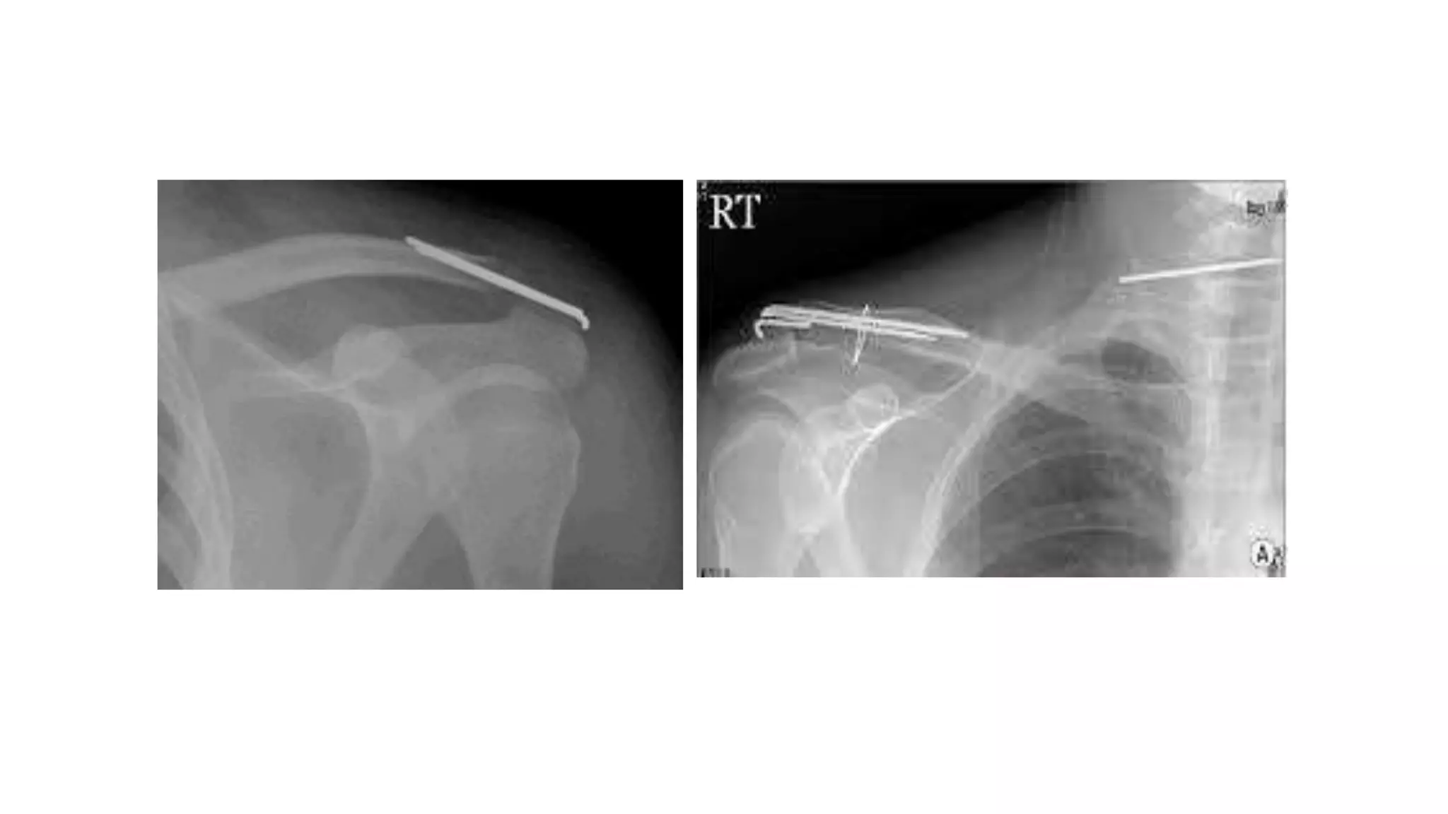 ACROMIOCLAVICULAR JOINT INJURY | PPTX