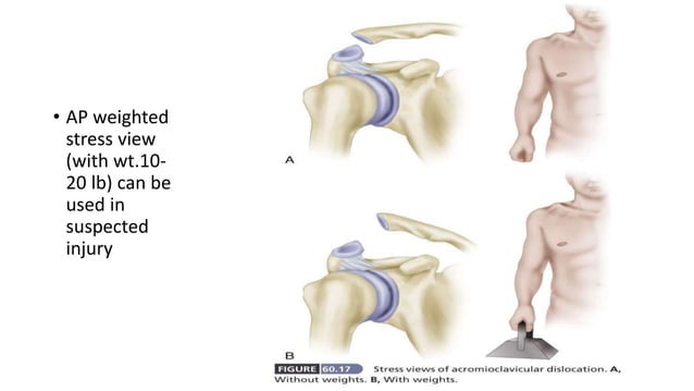 ACROMIOCLAVICULAR JOINT INJURY | PPTX | Death, Injury, or Military ...