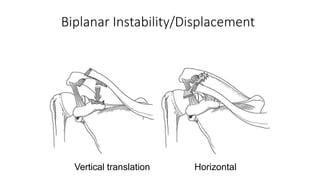 ACROMIOCLAVICULAR JOINT INJURY | PPTX