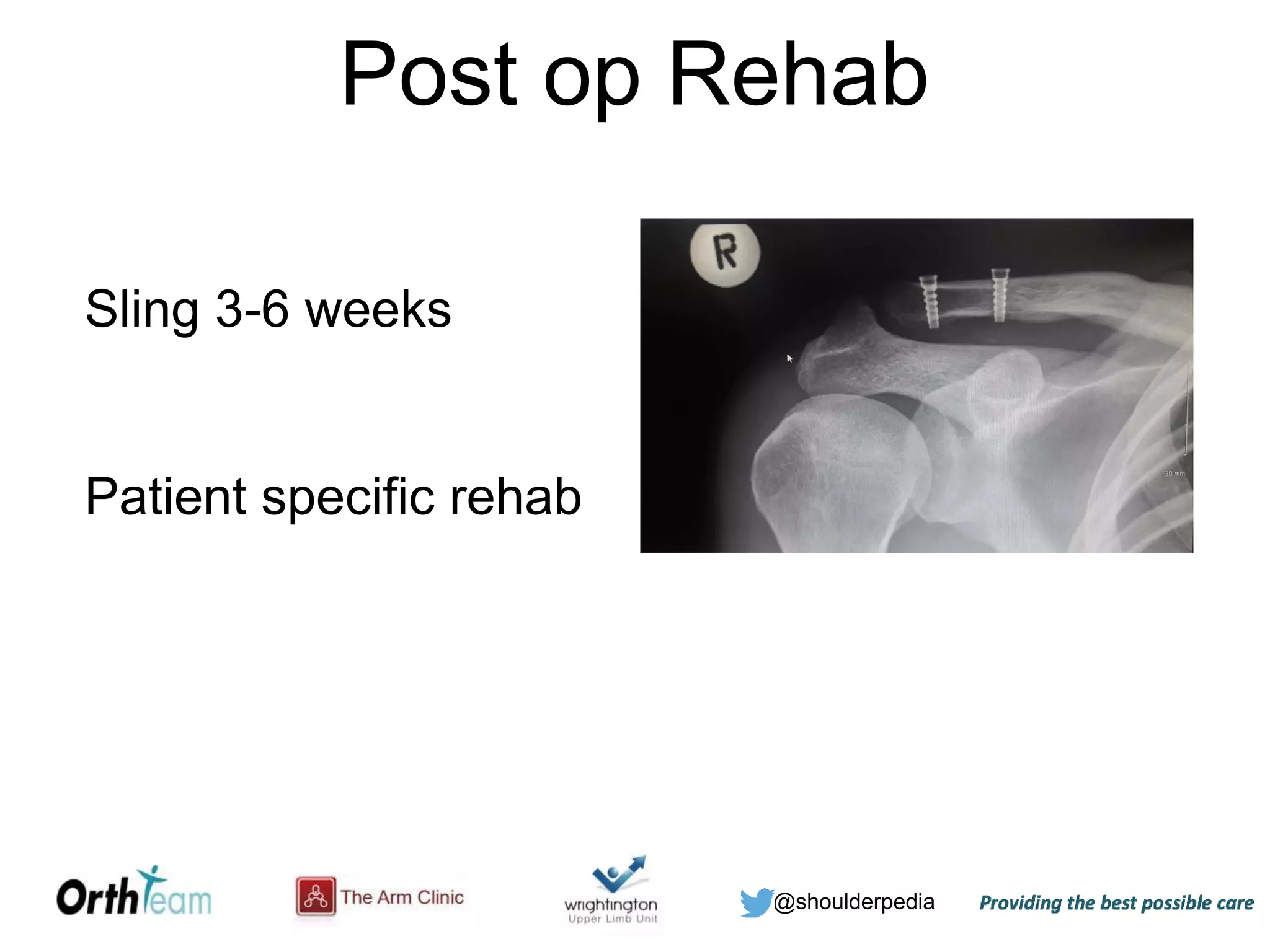 @shoulderpedia
Post op Rehab
Sling 3-6 weeks
Patient specific rehab