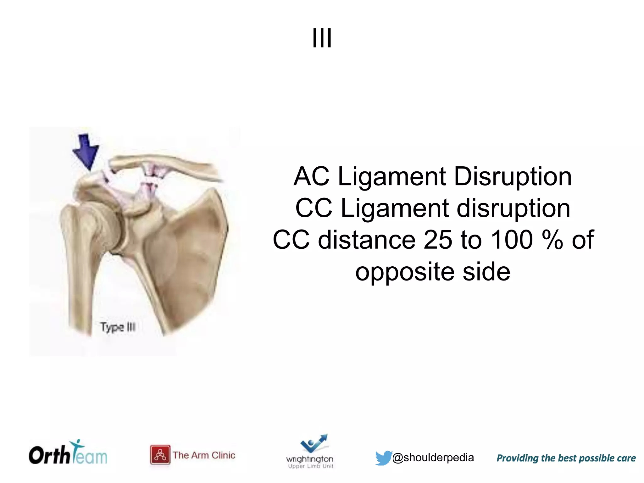 @shoulderpedia
III
AC Ligament Disruption
CC Ligament disruption
CC distance 25 to 100 % of
opposite side