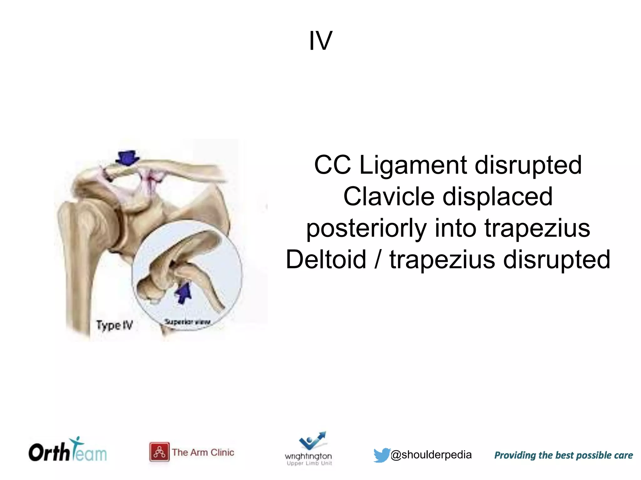 @shoulderpedia
IV
CC Ligament disrupted
Clavicle displaced
posteriorly into trapezius
Deltoid / trapezius disrupted