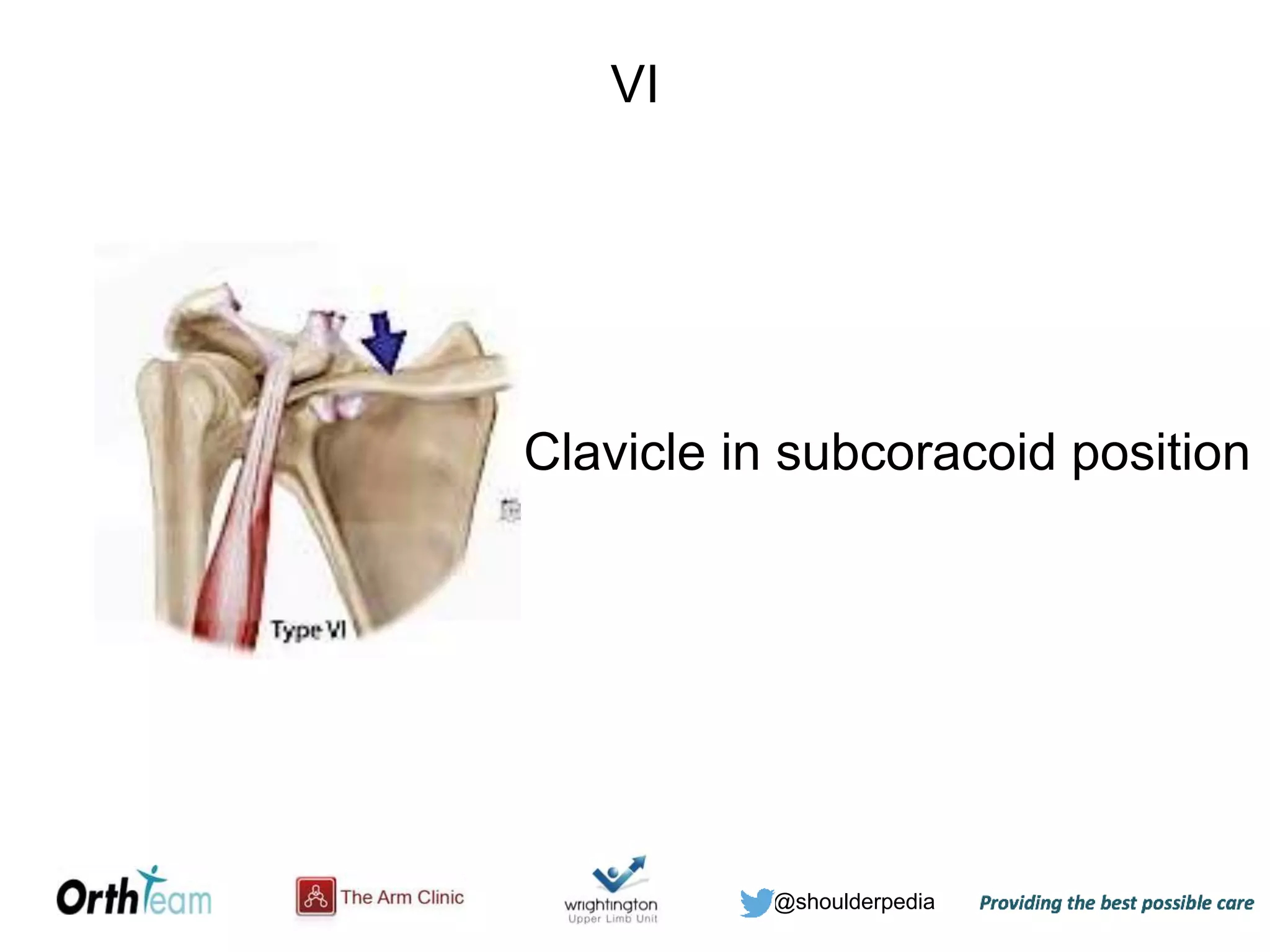 @shoulderpedia
VI
Clavicle in subcoracoid position