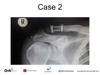 @shoulderpedia
Case 2
 