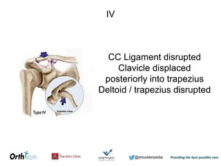 @shoulderpedia
IV
CC Ligament disrupted
Clavicle displaced
posteriorly into trapezius
Deltoid / trapezius disrupted
 
