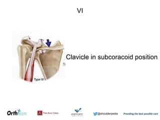 @shoulderpedia
VI
Clavicle in subcoracoid position
 