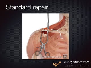 ACJ injury Myths Debunked | PDF