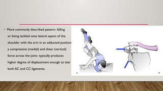• More commonly described pattern- falling
or being tackled onto lateral aspect of the
shoulder with the arm in an adducted position which produces
a compressive (medial) and shear (vertical)
force across the joint- typically produces
higher degree of displacement enough to tear
both AC and CC ligaments.
 