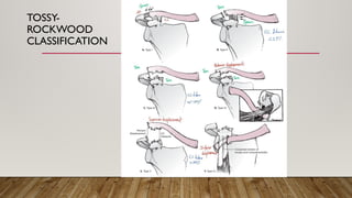 TOSSY-
ROCKWOOD
CLASSIFICATION
 