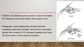 • Children and adolescents may sustain a variant of complete
AC dislocation (most often Salter–Harris type I or II)
• Radiographs reveal displacement of distal clavicular
metaphysis superiorly (through a dorsal rent in periosteal
sleeve) with increase in CC interspace. Epiphysis and intact
AC joint remain in their anatomic locations
 