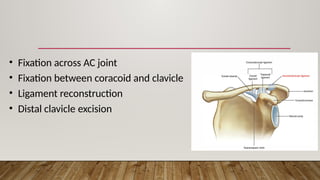 • Fixation across AC joint
• Fixation between coracoid and clavicle
• Ligament reconstruction
• Distal clavicle excision
 