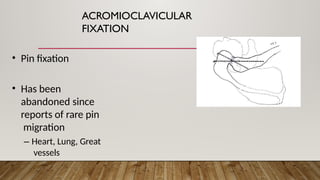 ACROMIOCLAVICULAR
FIXATION
• Pin fixation
• Has been
abandoned since
reports of rare pin
migration
– Heart, Lung, Great
vessels
 
