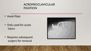 ACROMIOCLAVICULAR
FIXATION
• Hook Plate
• Only used for acute
injury
• Requires subsequent
surgery for removal
 