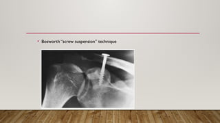 • Bosworth “screw suspension” technique
 