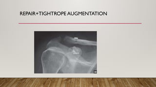 REPAIR+TIGHTROPE AUGMENTATION
 