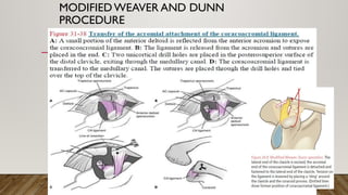 MODIFIEDWEAVER AND DUNN
PROCEDURE
 