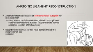 ANATOMIC LIGAMENT RECONSTRUCTION
• Alternative technique is use of semitendinosus autograft for
reconstruction
– Loop around or fix into coracoid, then fix through two
separate clavicle bone tunnels to approximate normal
anatomic location of CC ligaments
• Recent biomechanical studies have demonstrated the
superiority of this
construct
 