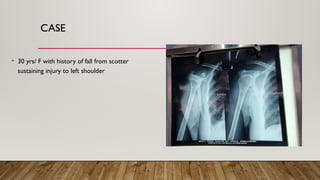 CASE
• 30 yrs/ F with history of fall from scotter
sustaining injury to left shoulder
 