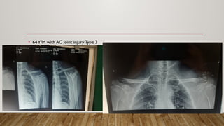 • 64Y/M with AC joint injury Type 3
 