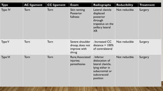 Type AC ligament CC ligament Exam Radiographs Reducibility Treatment
Type IV Torn Torn Skin tenting
Posterior
fullness
Lateral clavicle
displaced
posterior
through
trapezius on the
axillary lateral
XR
Not reducible Surgery
TypeV Torn Torn Severe shoulder
droop, does not
improve with
shrug
. Increased CC
distance > 100%
of contralateral
Not reducible Surgery
TypeVI Torn Torn Rare;Associated
injuries;
paresthesias
. Inferior
dislocation of
lateral clavicle,
lying either in
subacromial or
subcoracoid
position
Not reducible Surgery
 