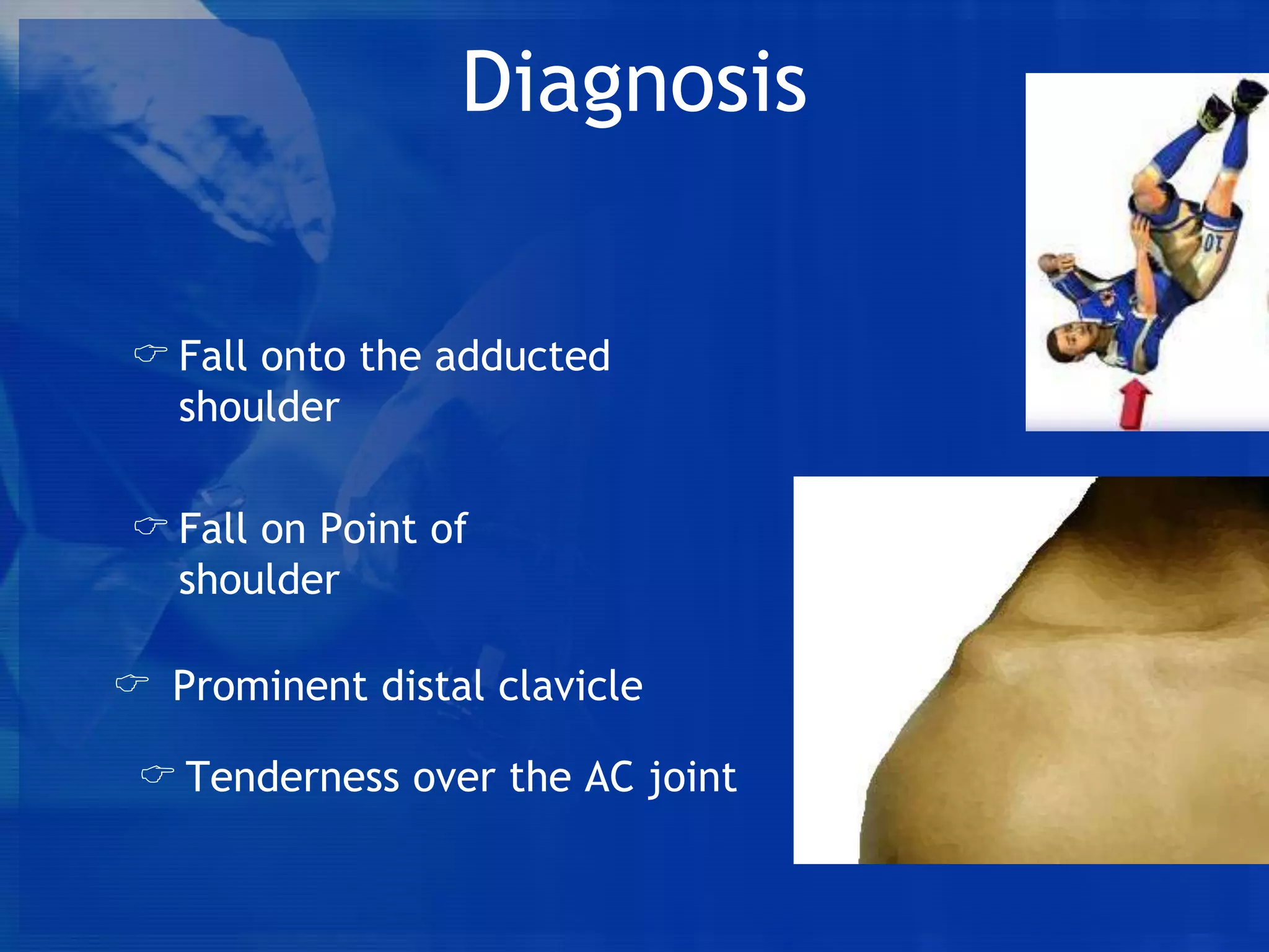 Diagnosis
 Fall onto the adducted
shoulder
 Fall on Point of
shoulder
 Prominent distal clavicle
 Tenderness over the AC joint

 