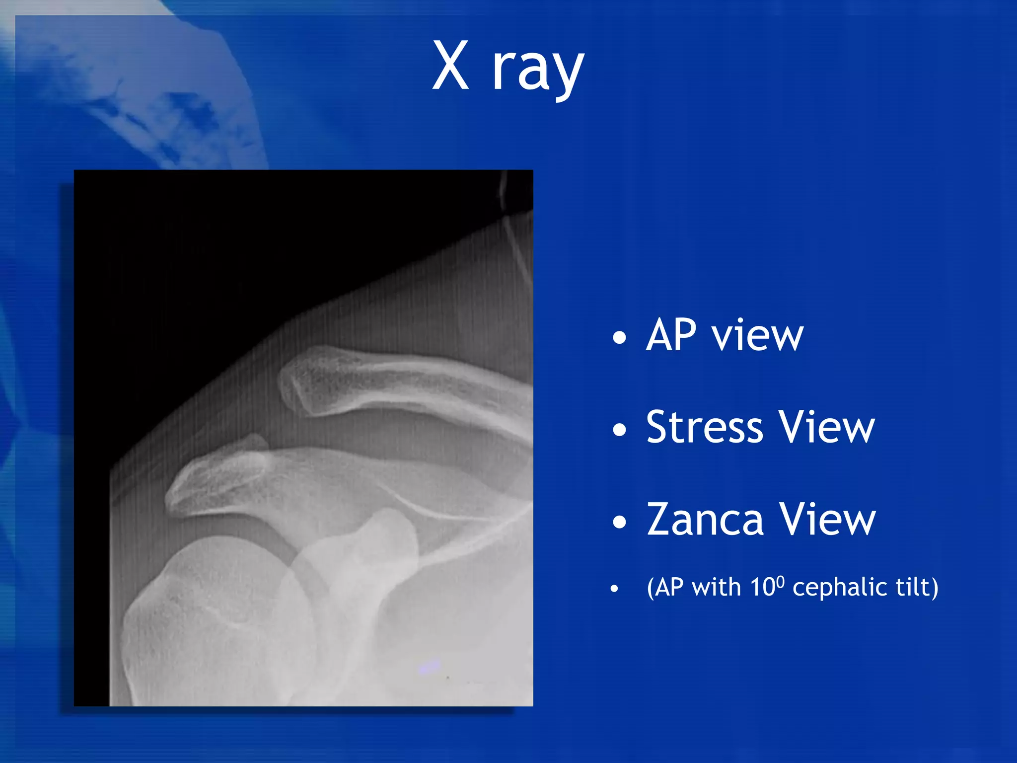X ray

• AP view
• Stress View

• Zanca View
• (AP with 100 cephalic tilt)

 
