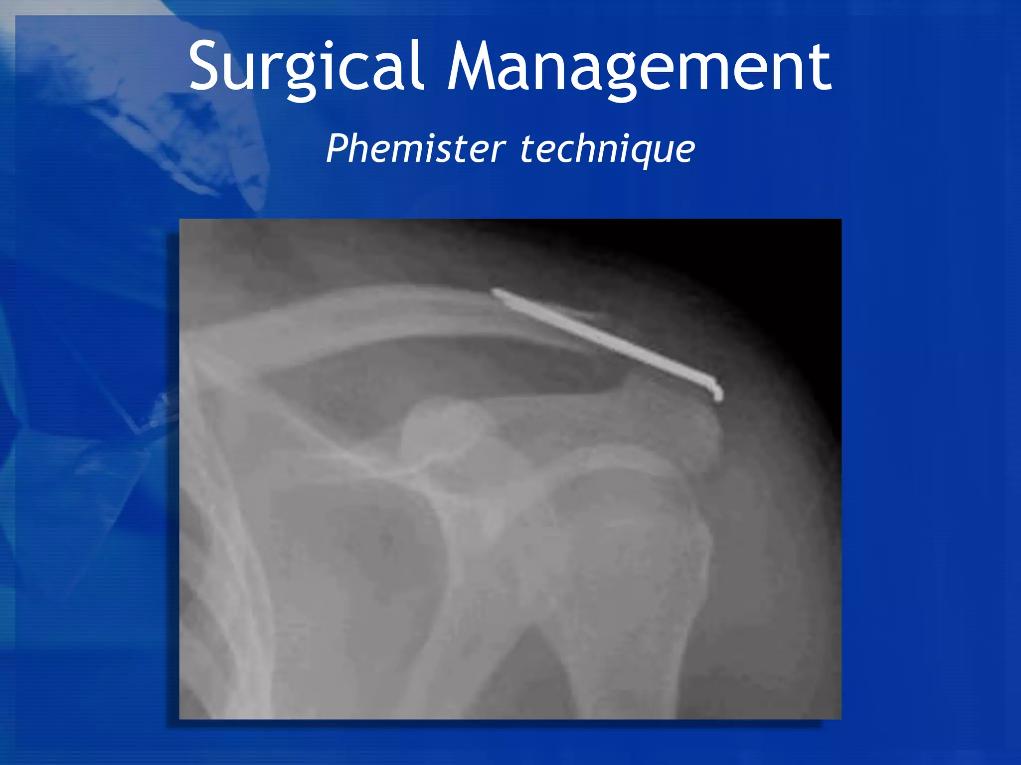 Surgical Management
Phemister technique

 