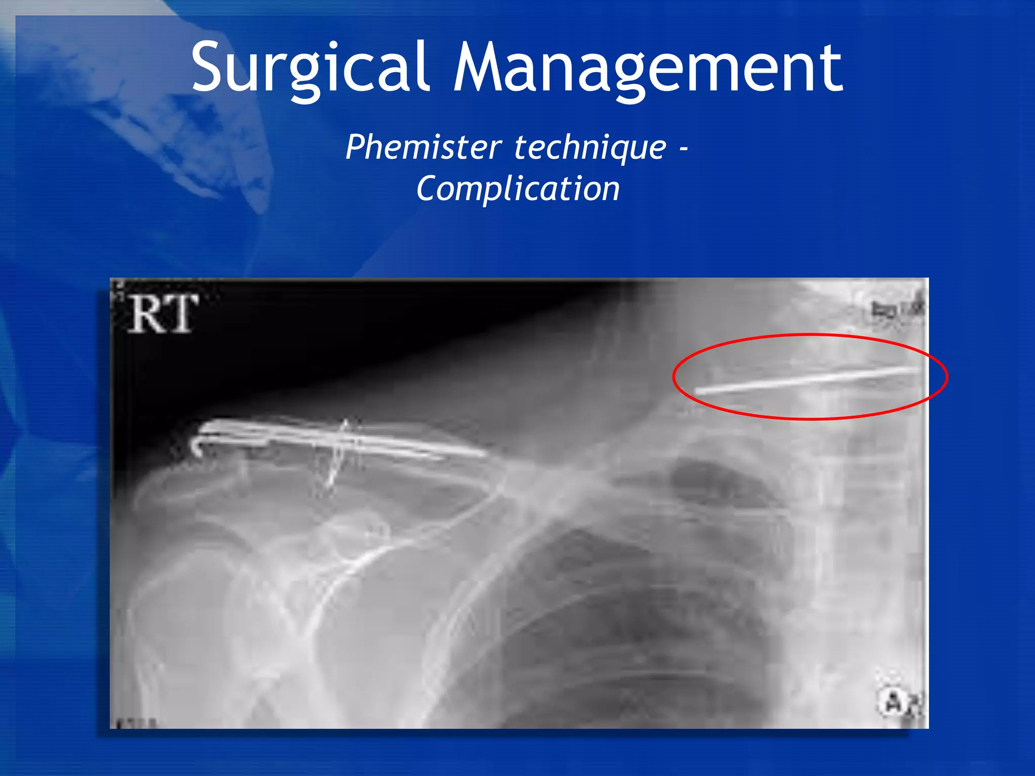 Surgical Management
Phemister technique Complication

 