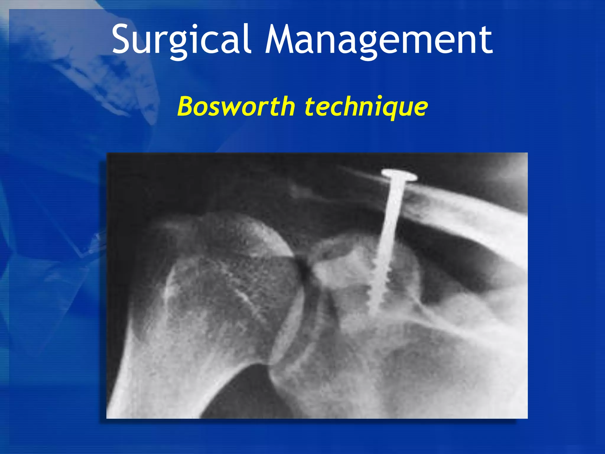 Surgical Management
Bosworth technique

 