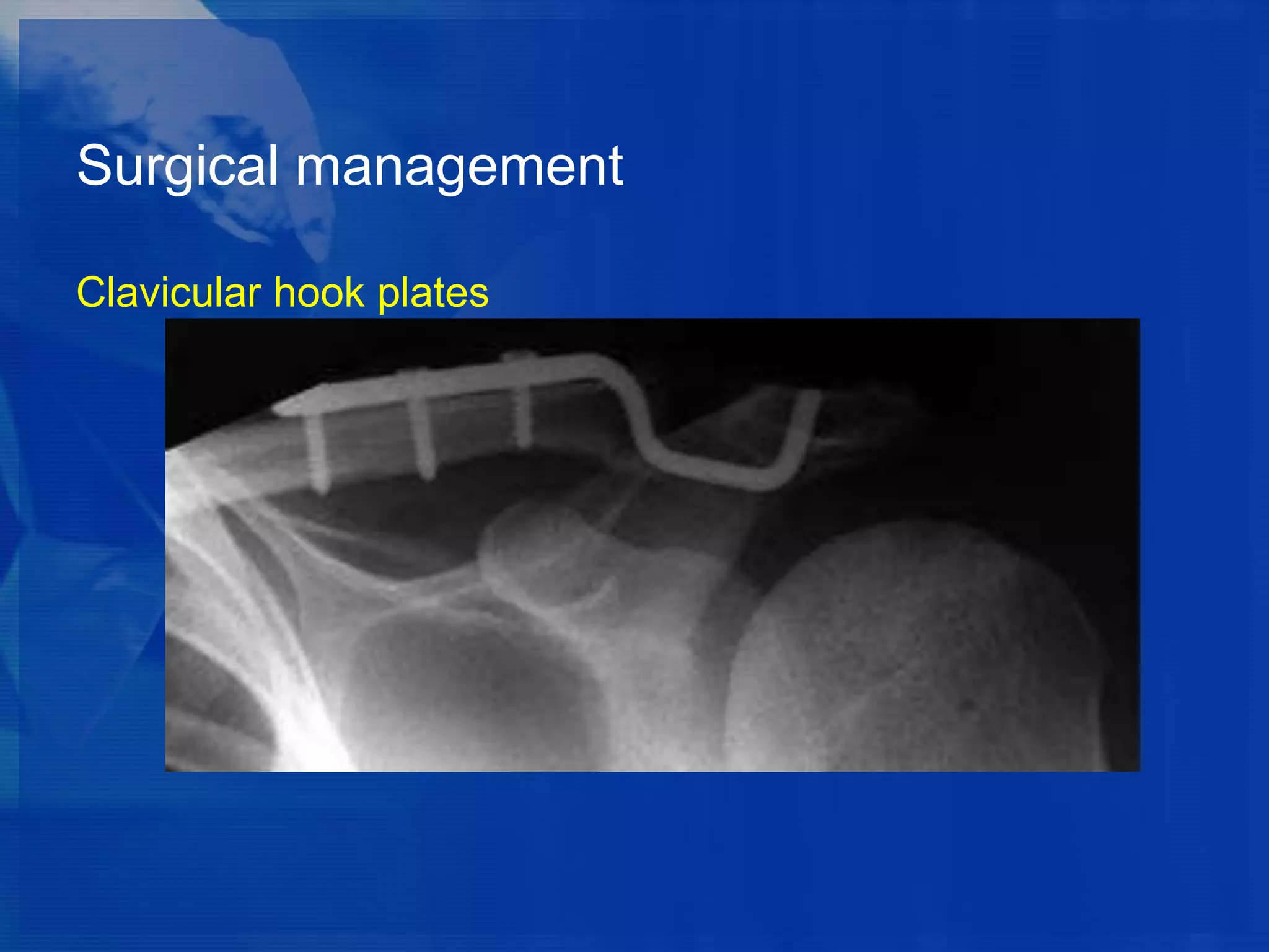 Surgical management
Clavicular hook plates

 
