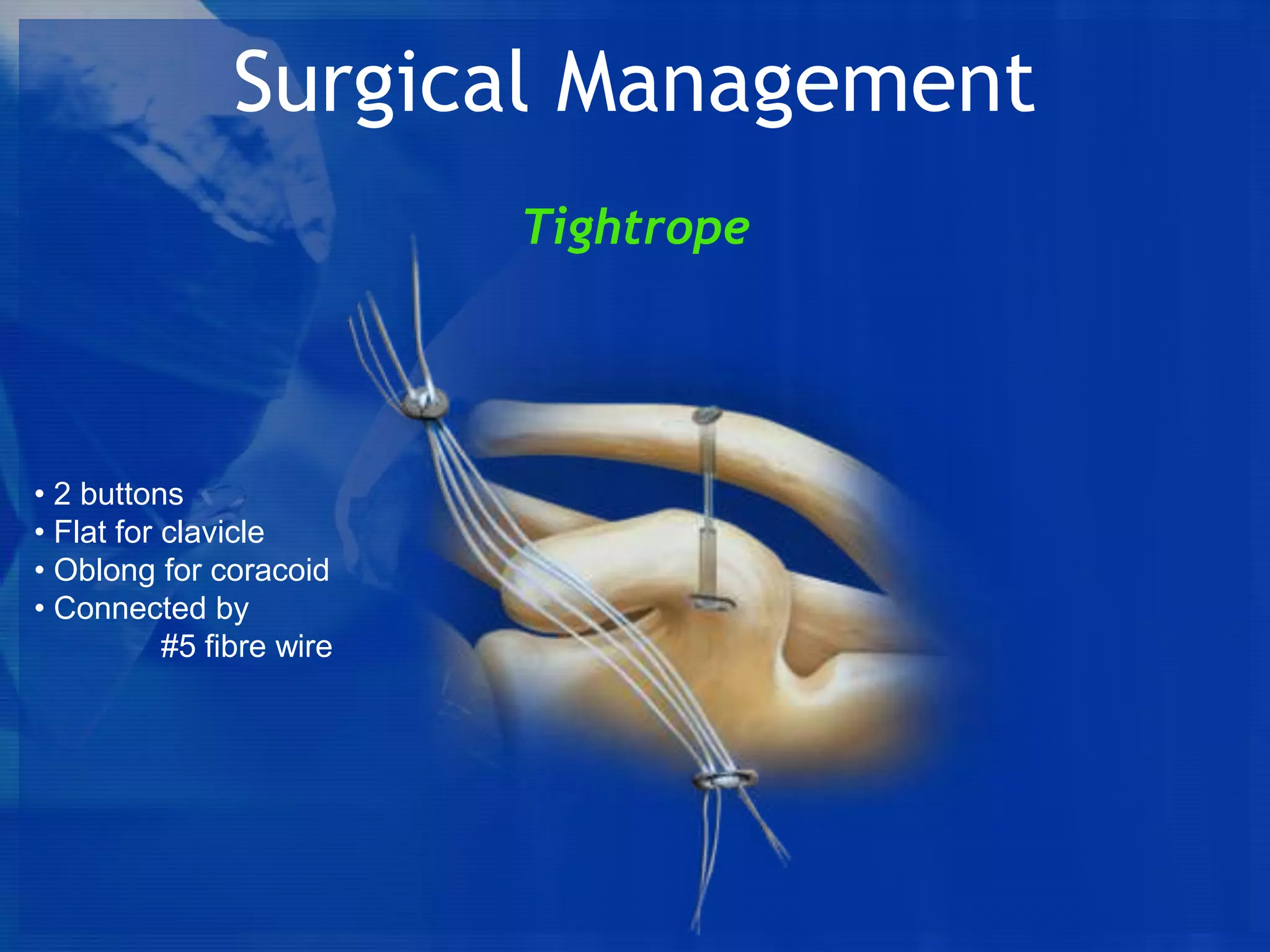 Surgical Management
Tightrope

• 2 buttons
• Flat for clavicle
• Oblong for coracoid
• Connected by
#5 fibre wire

 