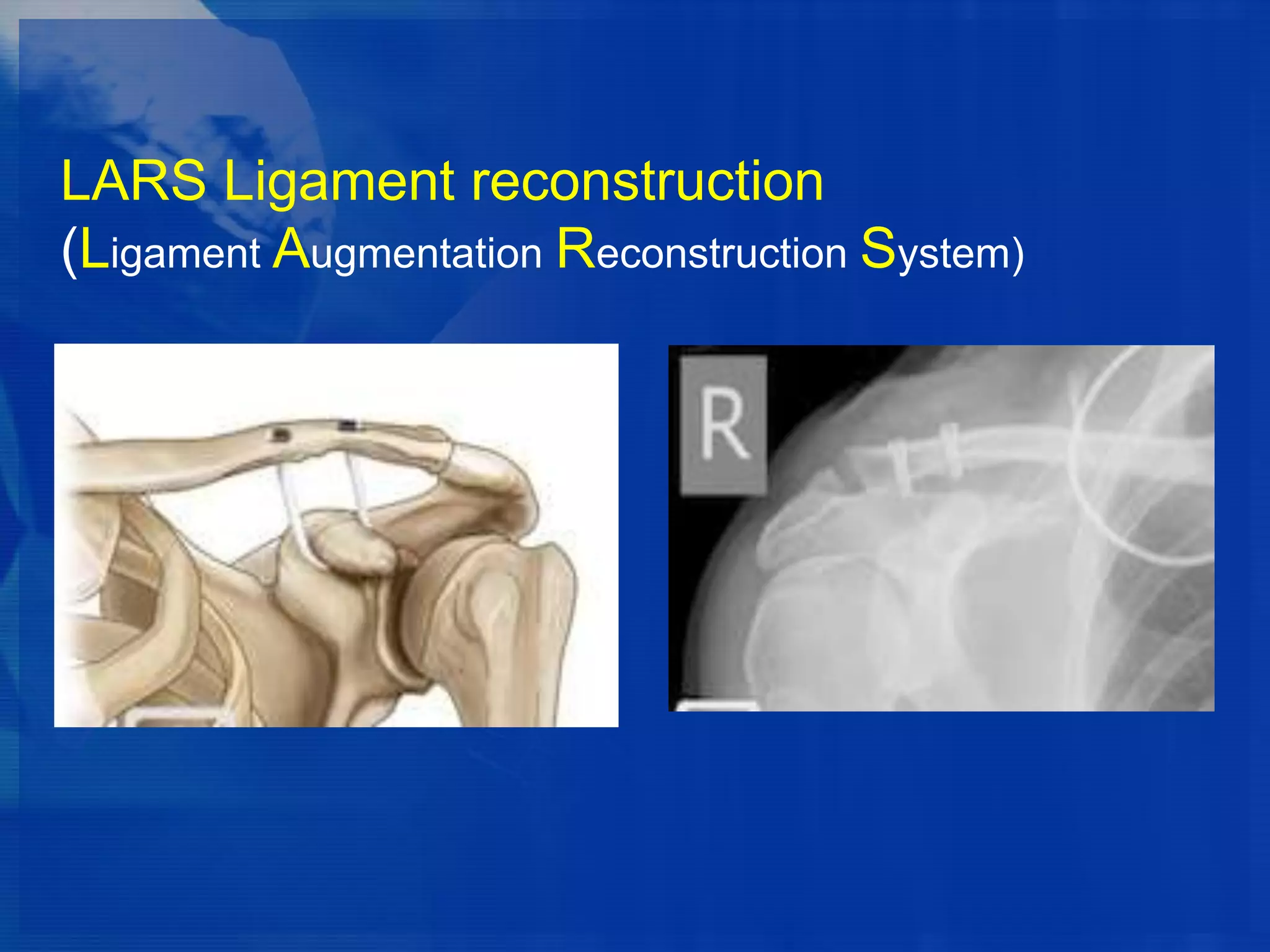 LARS Ligament reconstruction
(Ligament Augmentation Reconstruction System)

 