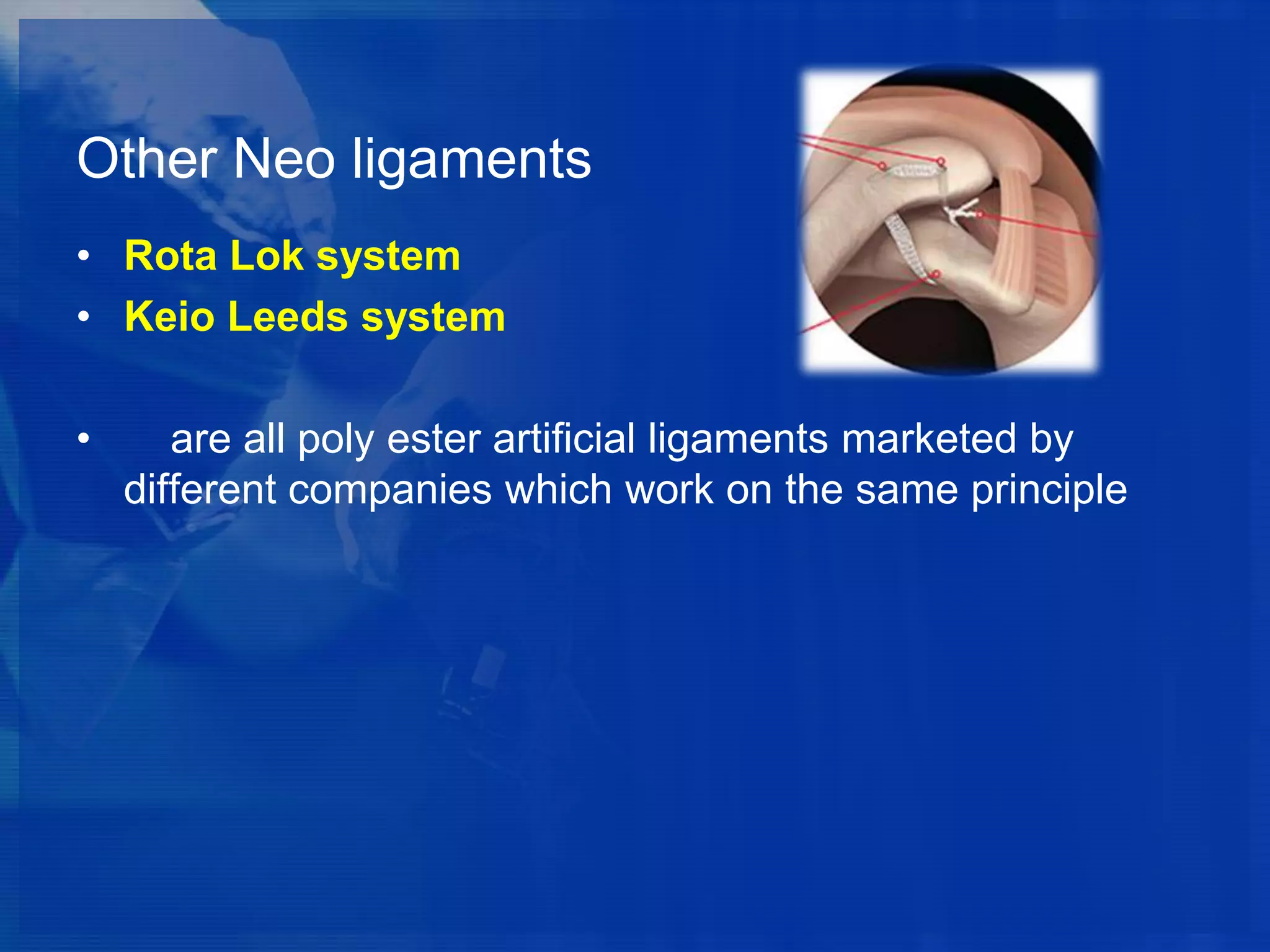 Other Neo ligaments
• Rota Lok system
• Keio Leeds system
•

are all poly ester artificial ligaments marketed by
different companies which work on the same principle

 