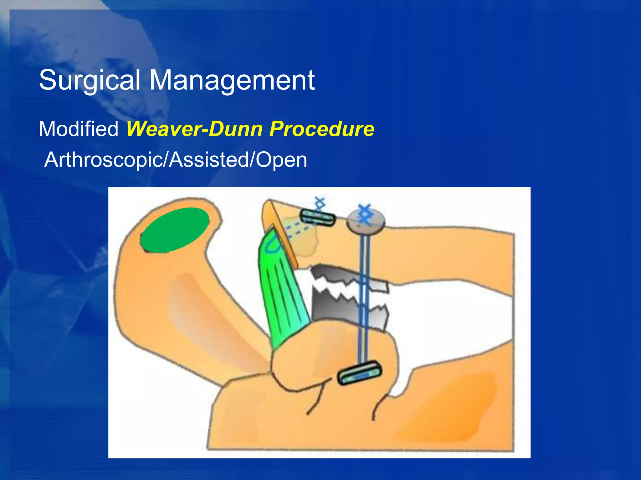 Surgical Management
Modified Weaver-Dunn Procedure
Arthroscopic/Assisted/Open

 