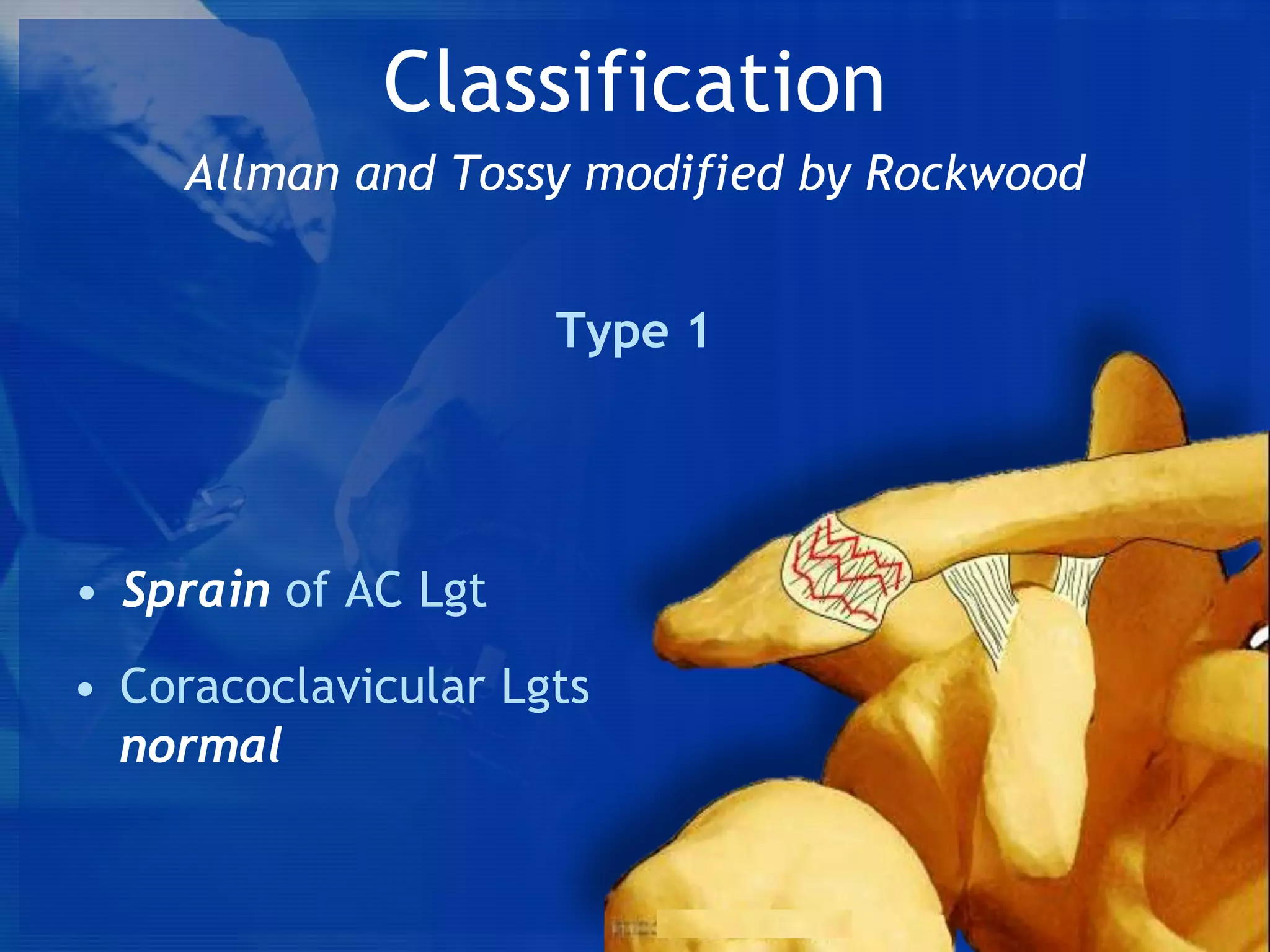 Classification
Allman and Tossy modified by Rockwood
Type 1

• Sprain of AC Lgt
• Coracoclavicular Lgts
normal

 