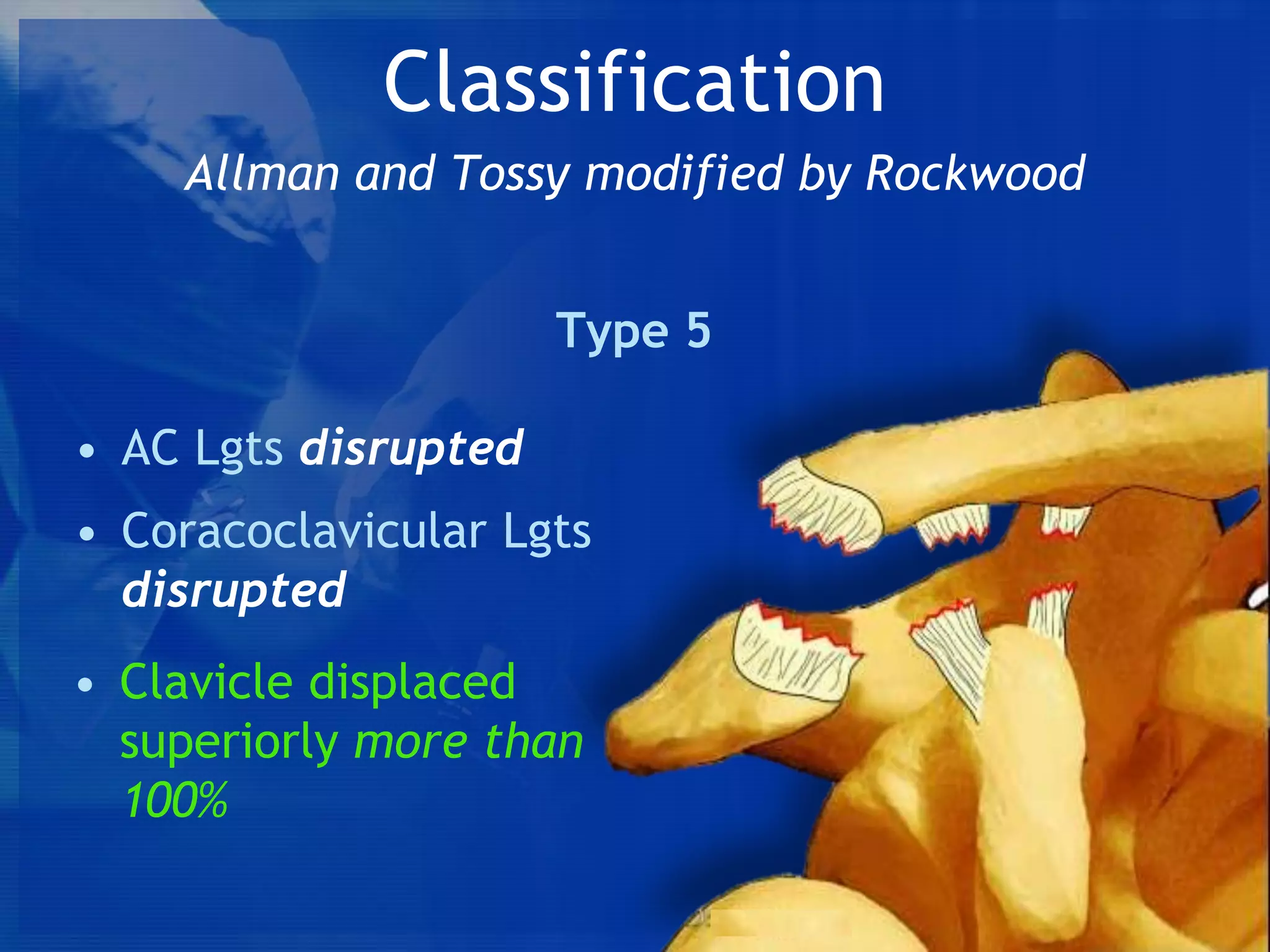 Classification
Allman and Tossy modified by Rockwood
Type 5
• AC Lgts disrupted
• Coracoclavicular Lgts
disrupted
• Clavicle displaced
superiorly more than
100%

 