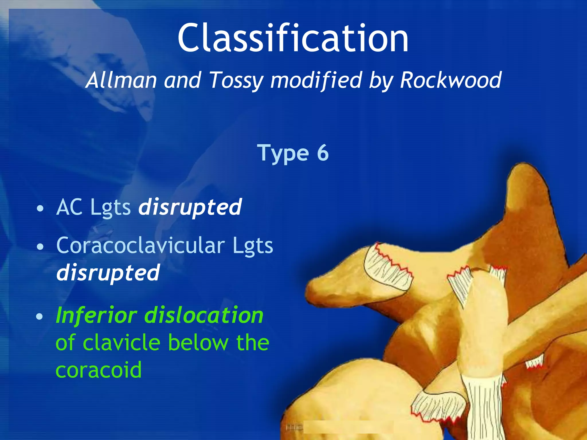 Classification
Allman and Tossy modified by Rockwood
Type 6
• AC Lgts disrupted
• Coracoclavicular Lgts
disrupted
• Inferior dislocation
of clavicle below the
coracoid

 