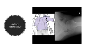 Ac joint dislocation.pptx