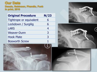14
Original Procedure N/23
Tightrope or equivalent 6
Lockdown / Surgilig 6
LARS 4
Weaver-Dunn 3
Hook Plate 3
Bosworth Screw 1
Our Data
Desais, Robinson, Phandis, Funk
In print, 2016
 