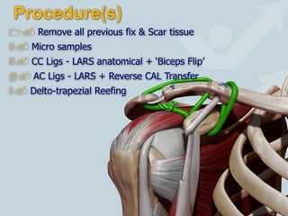 Procedure(s)
19
"# Remove all previous fix & Scar tissue
$# Micro samples
%# CC Ligs - LARS anatomical + ‘Biceps Flip’
&# AC Ligs - LARS + Reverse CAL Transfer
'# Delto-trapezial Reefing
 