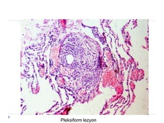 Pleksiform lezyon
 